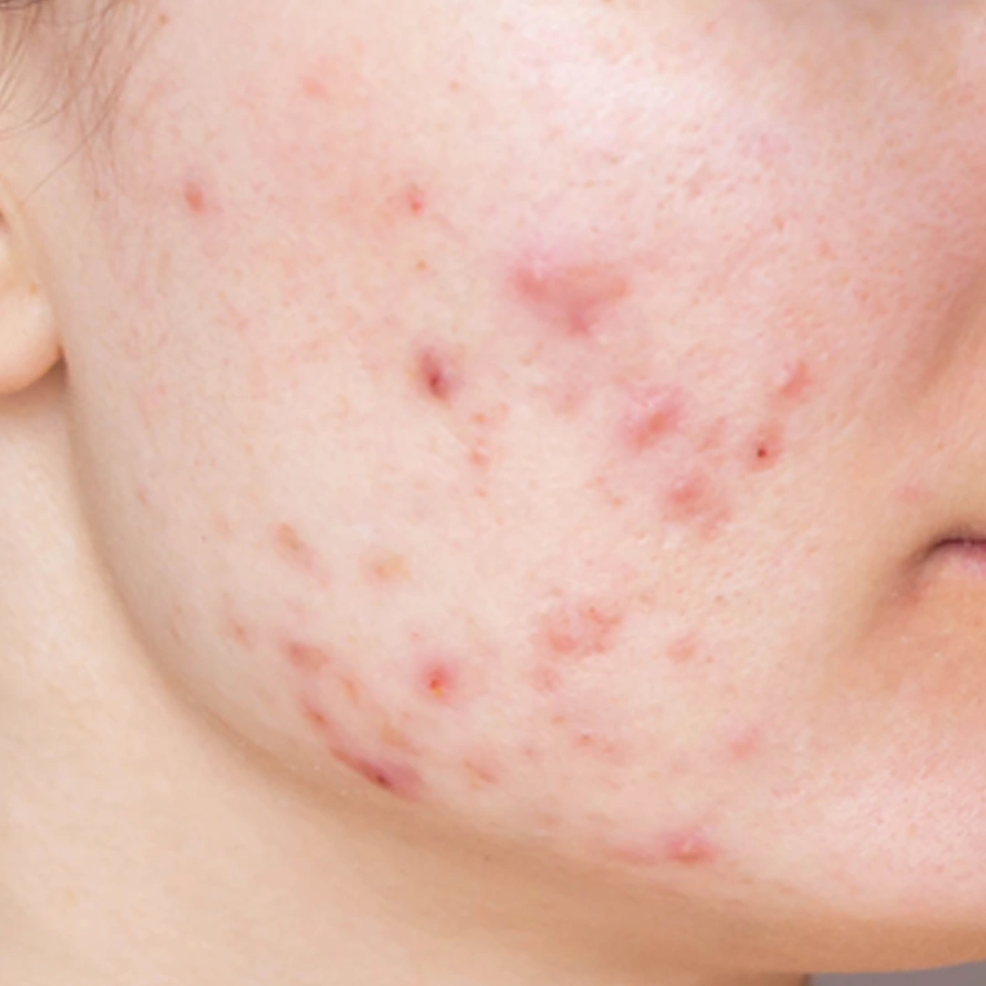 ReVive_Services_Before_&_After_Acne_Scar_Solutions_1