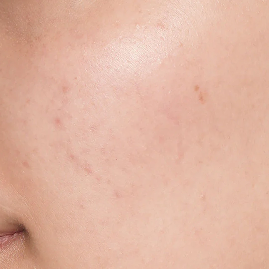 ReVive_Services_Before_&_After_BioRepeel_Advanced_Exfoliation_1