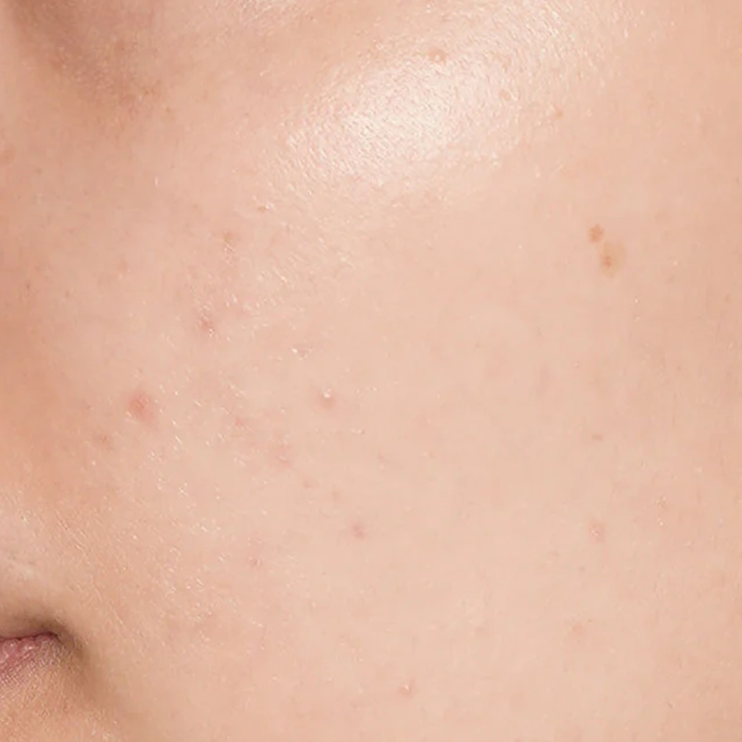 ReVive_Services_Before_&_After_BioRepeel_Advanced_Exfoliation_2