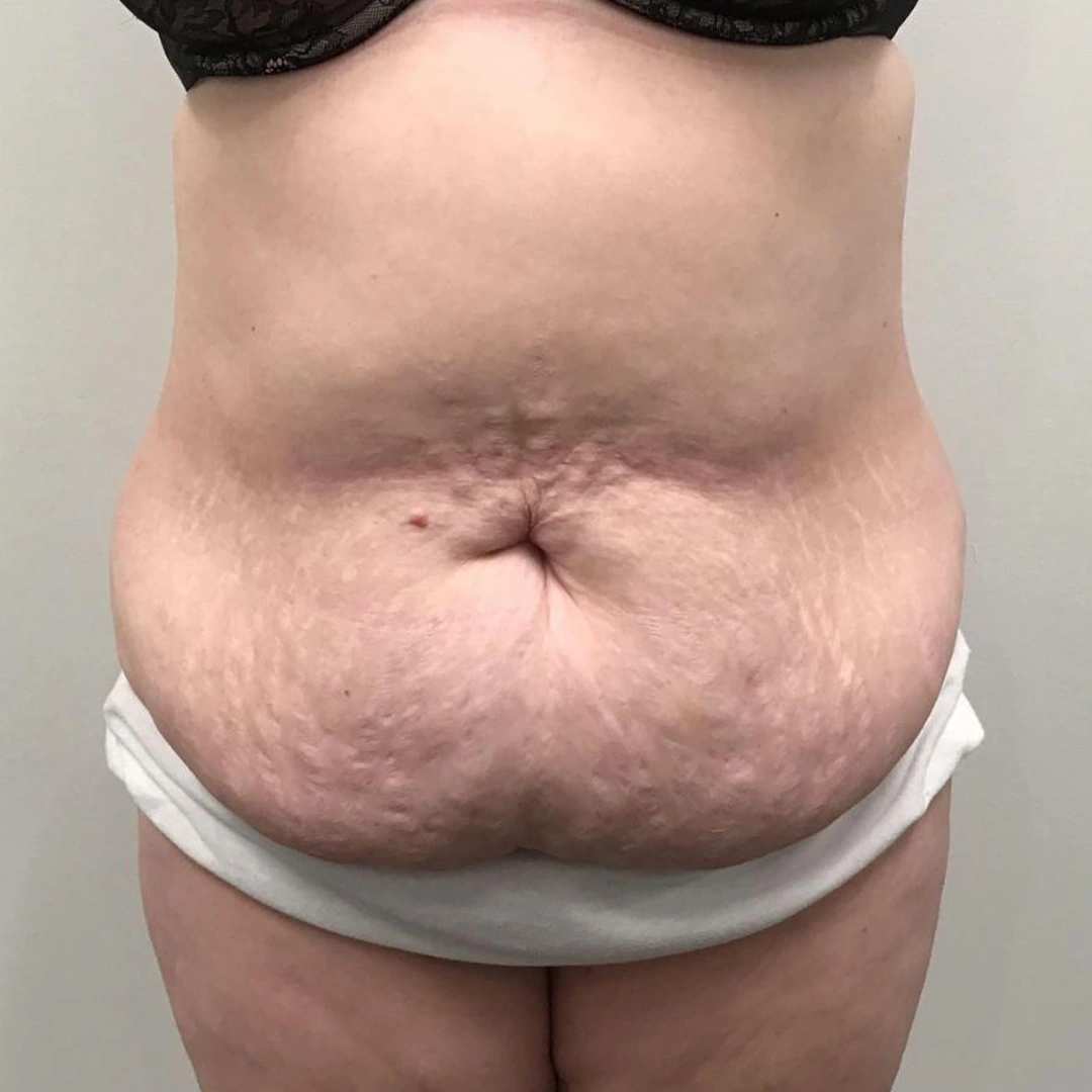 ReVive_Services_Before_&_After_Body_Consulting_&_Cellulite_Solutions_1 ReVive_Services_Before_&_After_Body_Consulting_&_Cellulite_Solutions_1