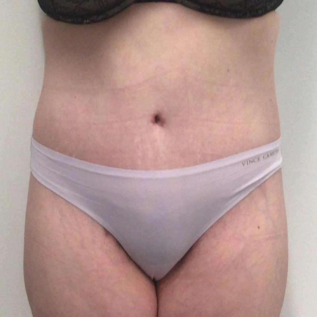 ReVive_Services_Before_&_After_Body_Consulting_&_Cellulite_Solutions_2 ReVive_Services_Before_&_After_Body_Consulting_&_Cellulite_Solutions_2