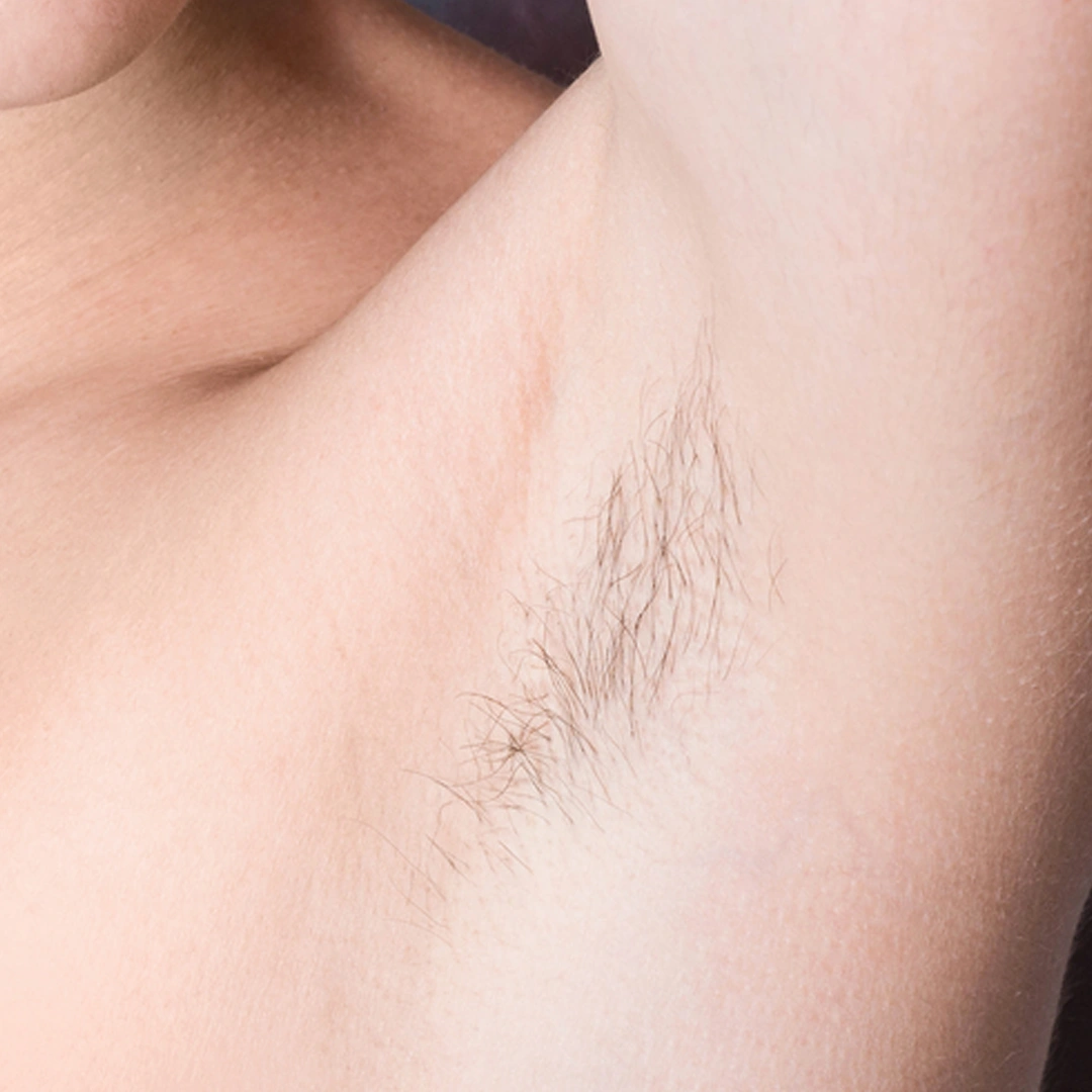 ReVive_Services_Before_&_After_Laser_Hair_Removal_1 ReVive_Services_Before_&_After_Laser_Hair_Removal_1