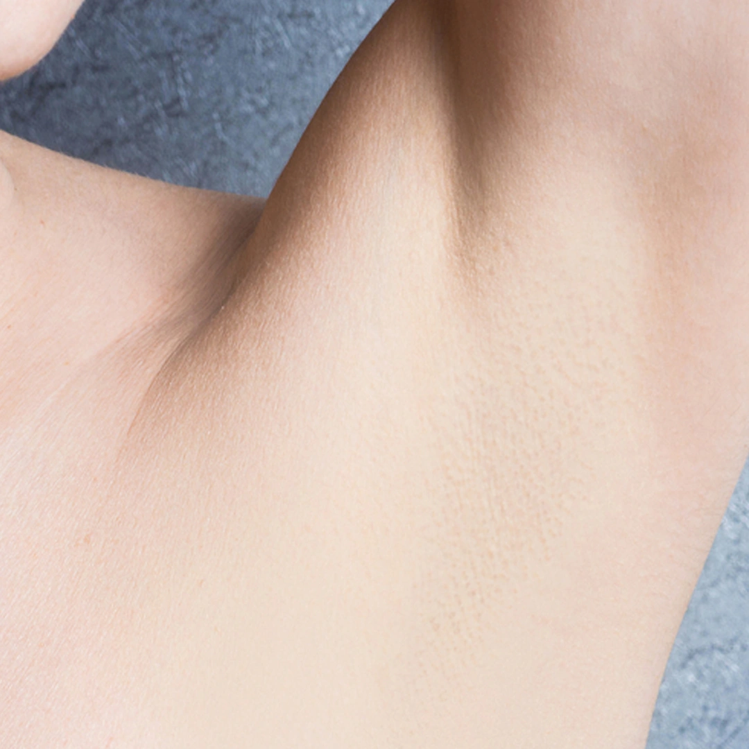 ReVive_Services_Before_&_After_Laser_Hair_Removal_2 ReVive_Services_Before_&_After_Laser_Hair_Removal_2