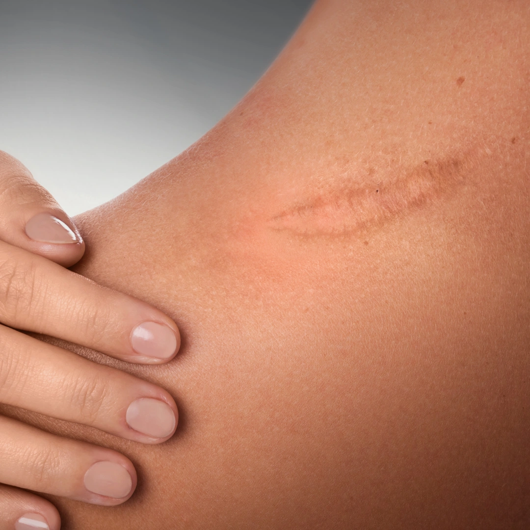 ReVive_Services_Before_&_After_Laser_Skin_Rejuvenation_1