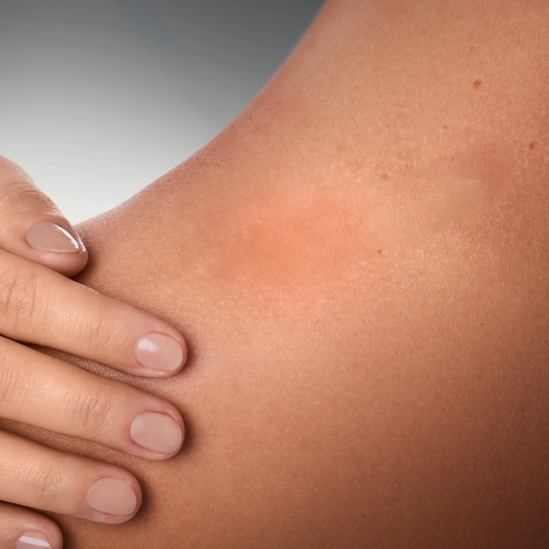 ReVive_Services_Before_&_After_Laser_Skin_Rejuvenation_2