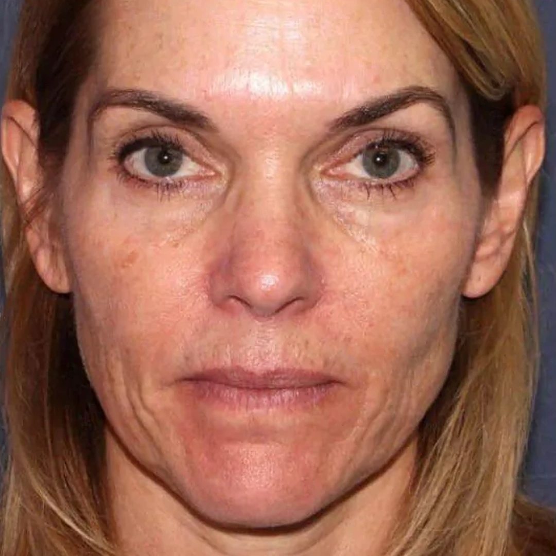 ReVive_Services_Before_&_After_Laser_Skin_Treatment_1 ReVive_Services_Before_&_After_Laser_Skin_Treatment_1