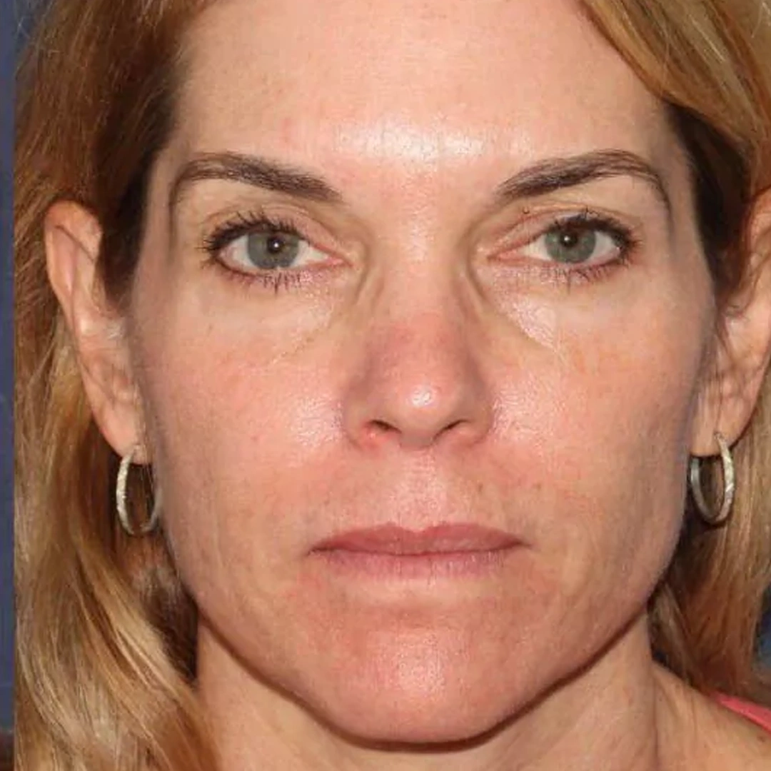 ReVive_Services_Before_&_After_Laser_Skin_Treatment_2 ReVive_Services_Before_&_After_Laser_Skin_Treatment_2