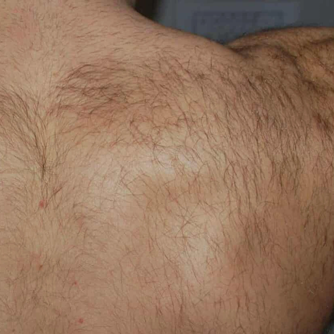ReVive_Services_Before_&_After_Laser_Therapy_For_Men_1 ReVive_Services_Before_&_After_Laser_Therapy_For_Men_1