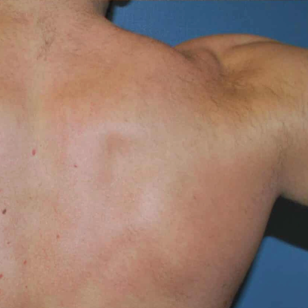 ReVive_Services_Before_&_After_Laser_Therapy_For_Men_2 ReVive_Services_Before_&_After_Laser_Therapy_For_Men_2