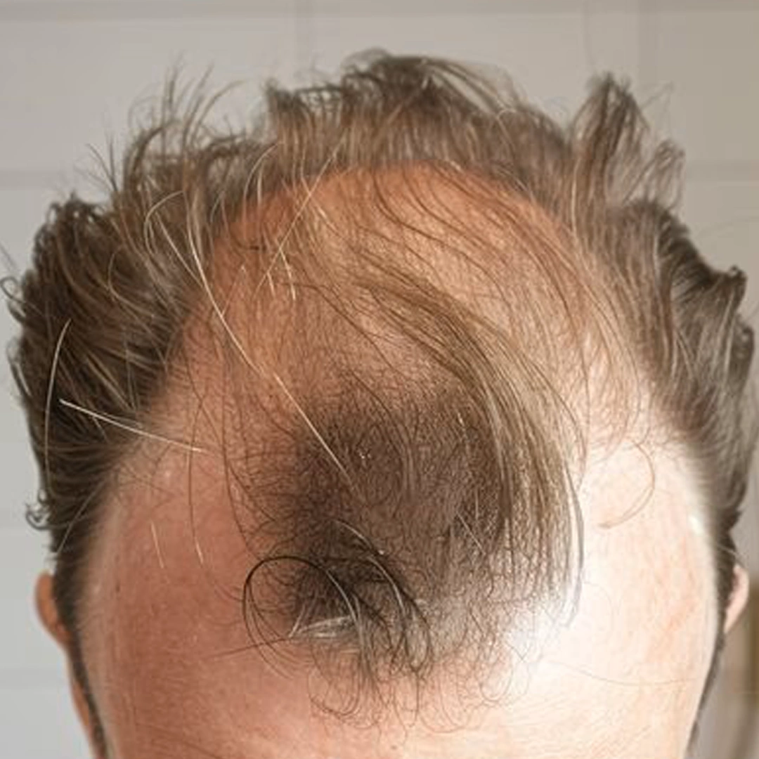 ReVive_Services_Before_&_After_Stem_Cell_Therapy_1
