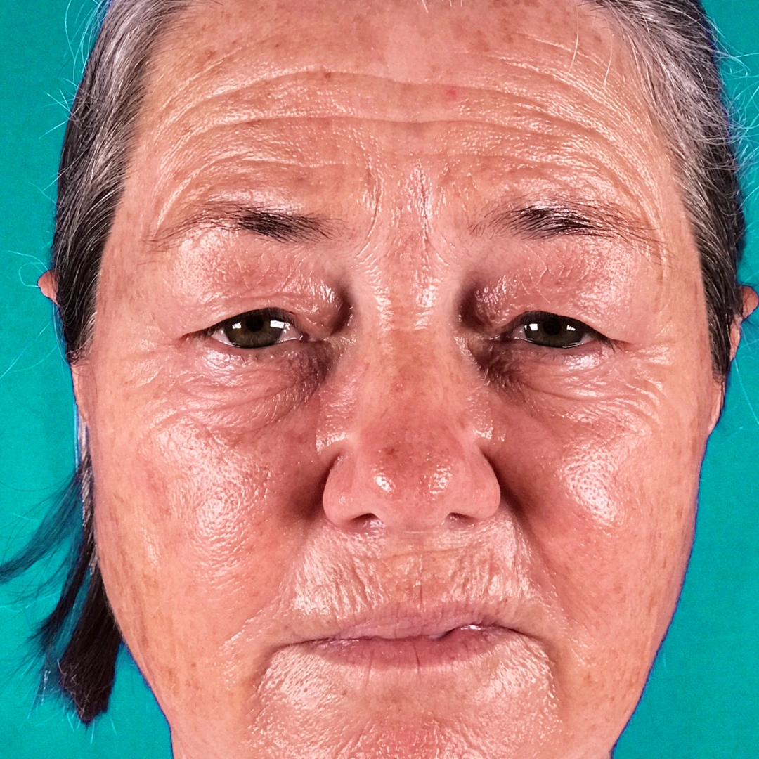 ReVive_Services_Before_&_After_Stem_Cell_Therapy_Skin_1 ReVive_Services_Before_&_After_Stem_Cell_Therapy_Skin_1