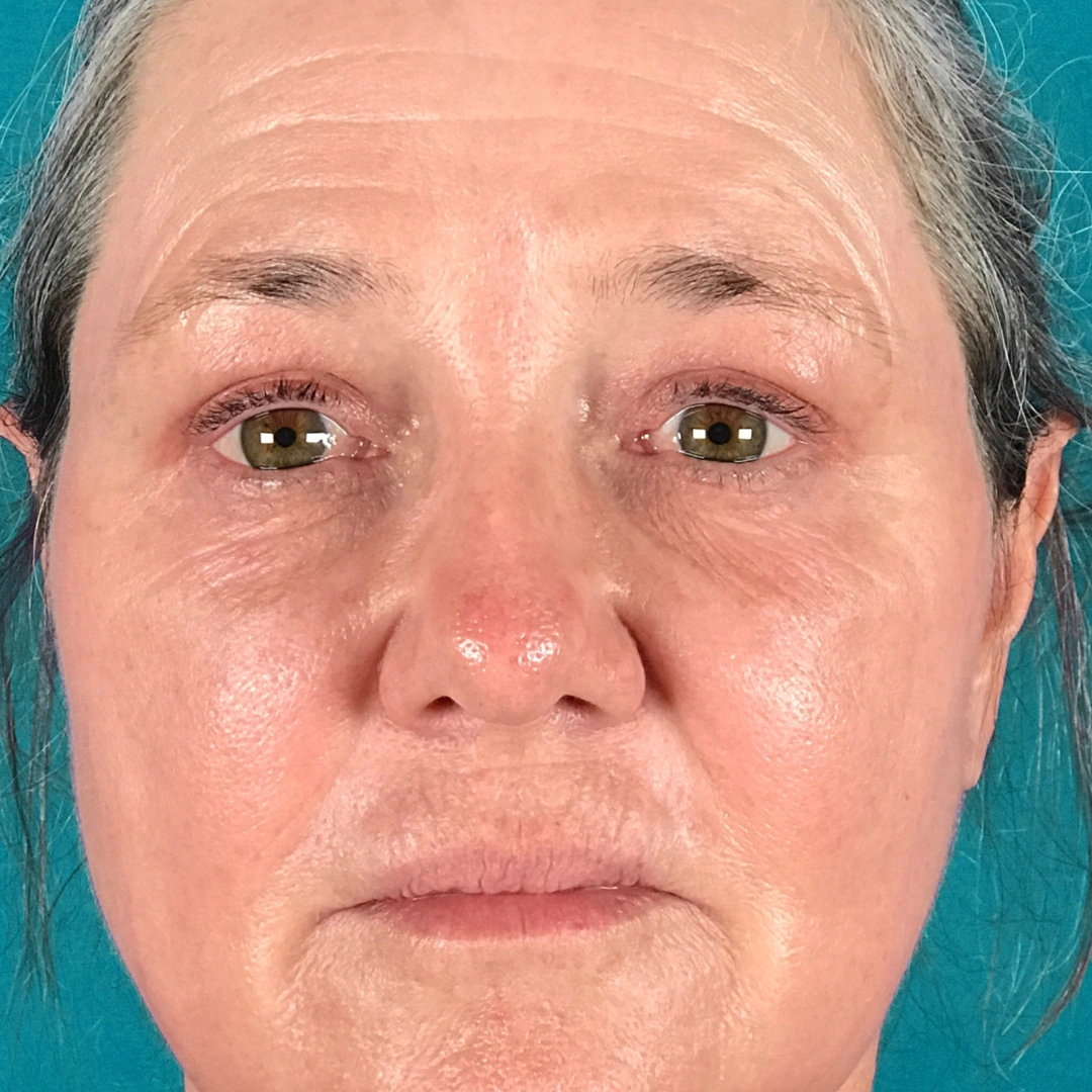 ReVive_Services_Before_&_After_Stem_Cell_Therapy_Skin_2 ReVive_Services_Before_&_After_Stem_Cell_Therapy_Skin_2