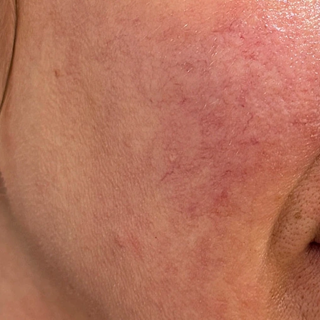 ReVive_Services_Before_&_After_Vitamin_IV_Hydration_Therapy_1 ReVive_Services_Before_&_After_Vitamin_IV_Hydration_Therapy_1