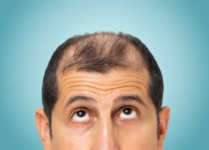 Man experiencing hair thinning issues, searching for personalized regrowth treatments in Brevard County